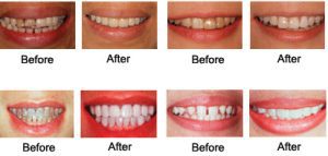 Cavity Treatments & Preventions