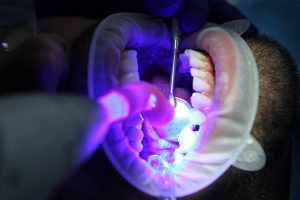 Cavity Treatments and Preventions