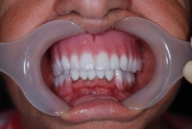 Complete Denture