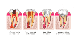 Root Canals