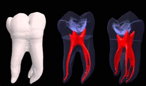 Root Canals