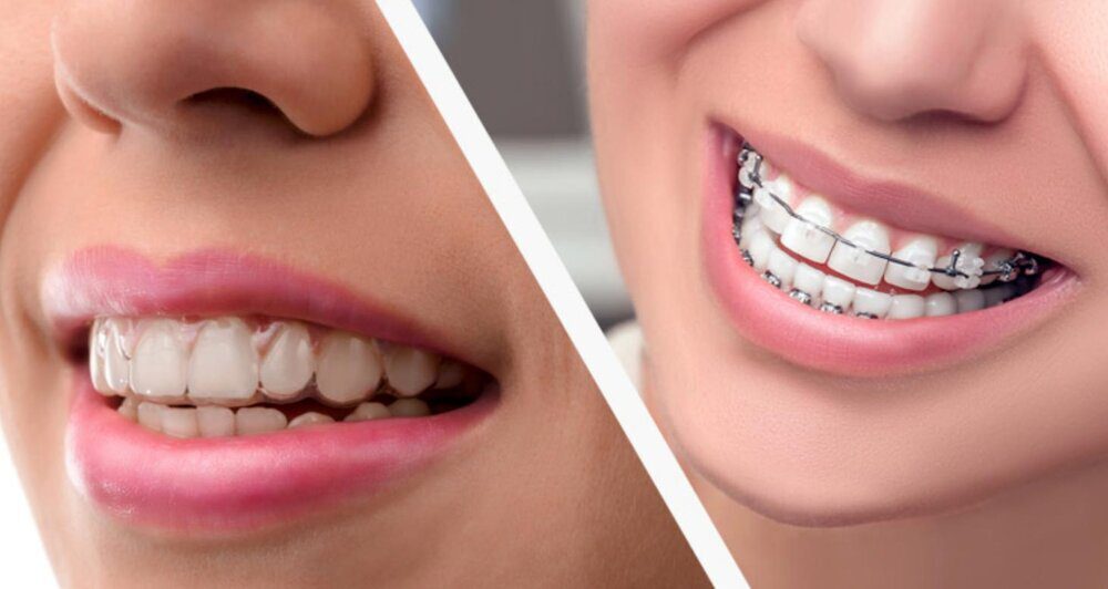 Why Invisalign is Right for You