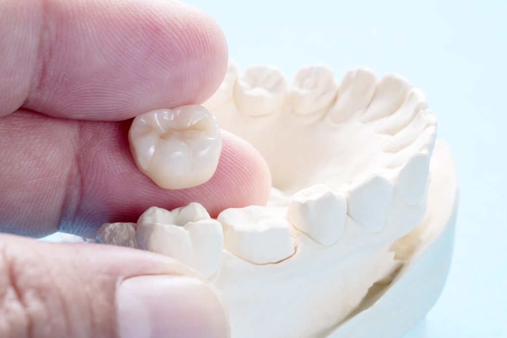 Vienna Residents : Exploring the Benefits of Dental Bridge