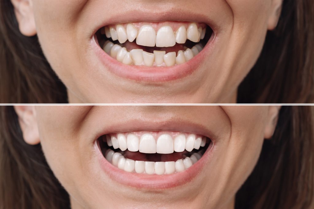 Smile Makeovers with Dental Veneers: A Guide for Vienna