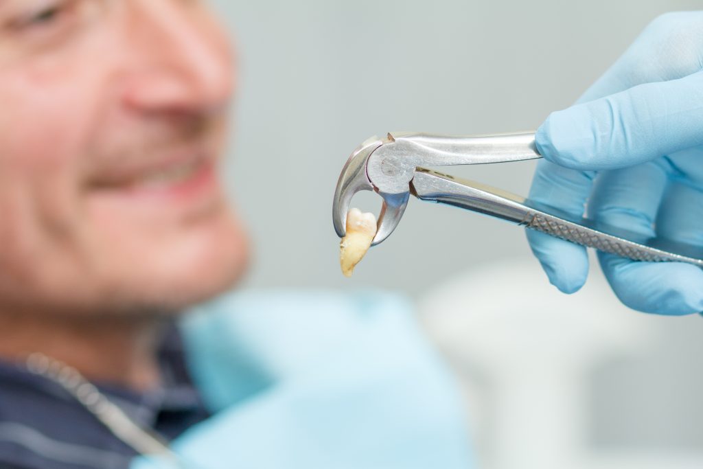 Tooth Extractions : A Best Guide for Vienna Residents