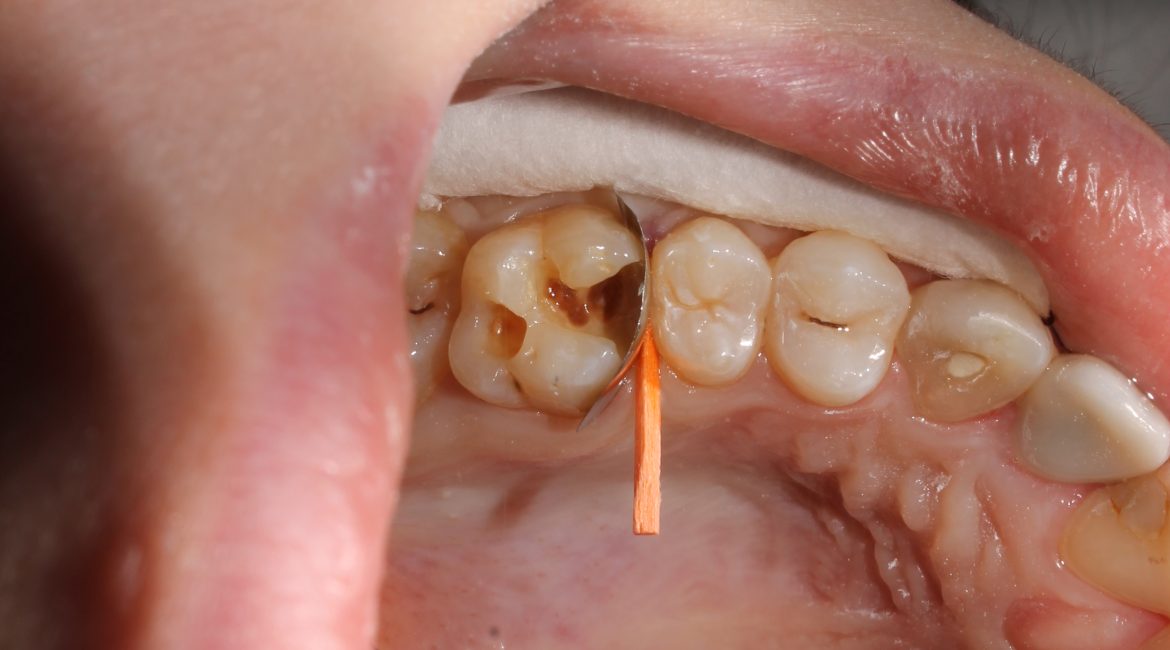 Root Canal Treatment