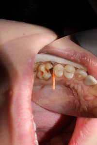 Root Canal Treatment