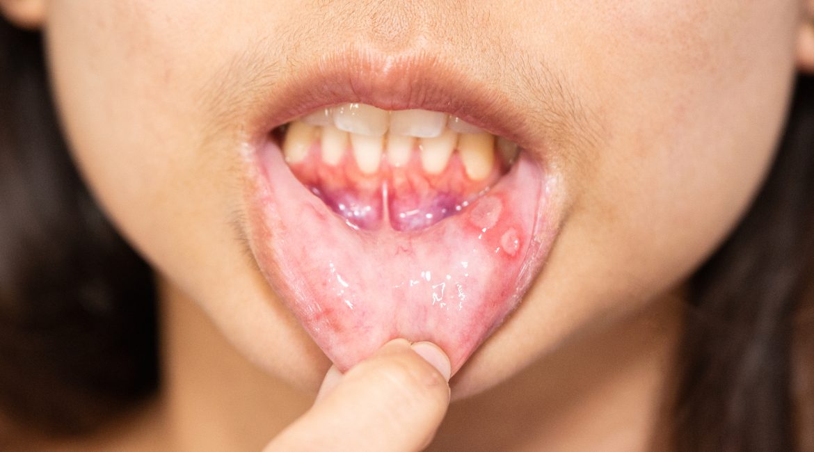 Gum Disease Prevention