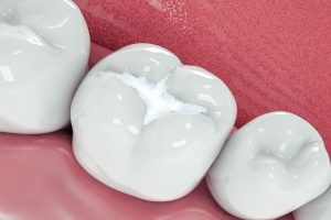 Dental Sealants