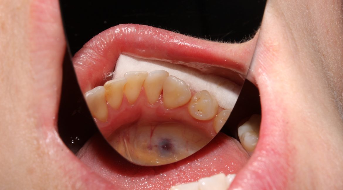 Oral Infections