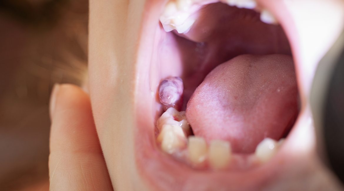 Early Detection of Oral Cancer