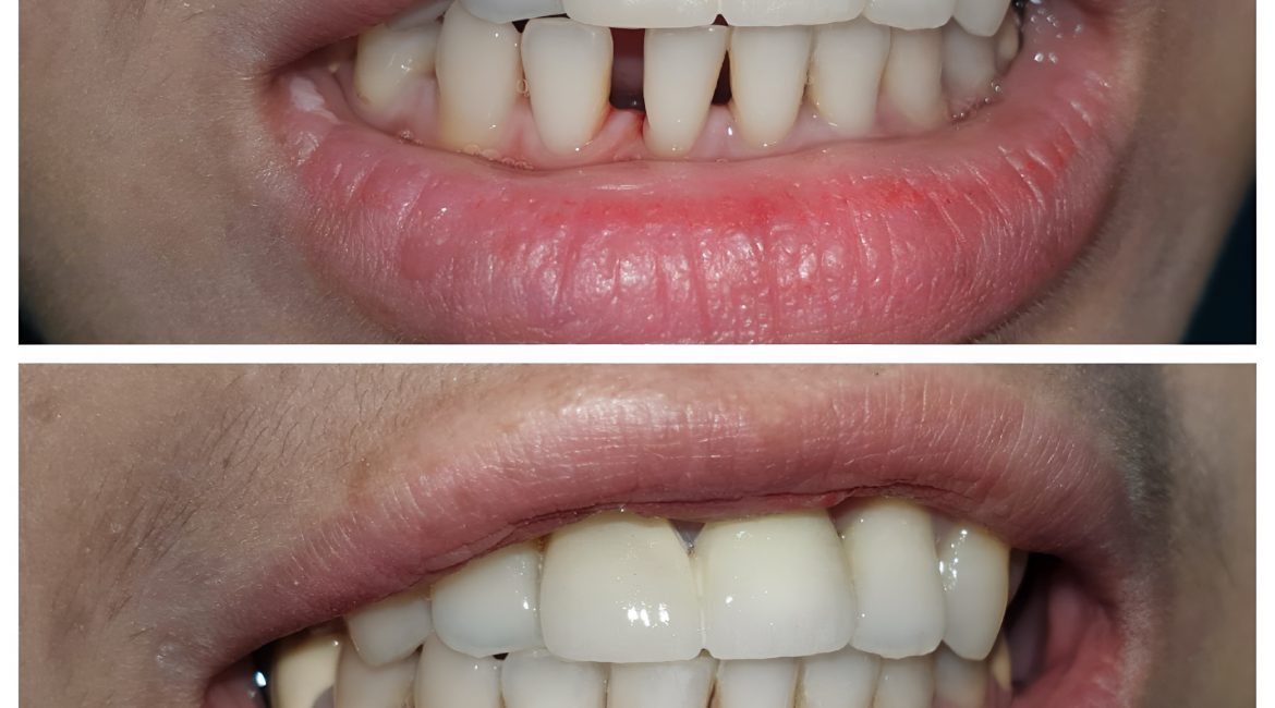 Dental Bridges