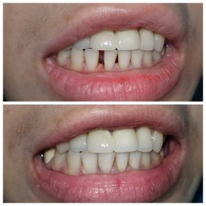 Dental Bridges