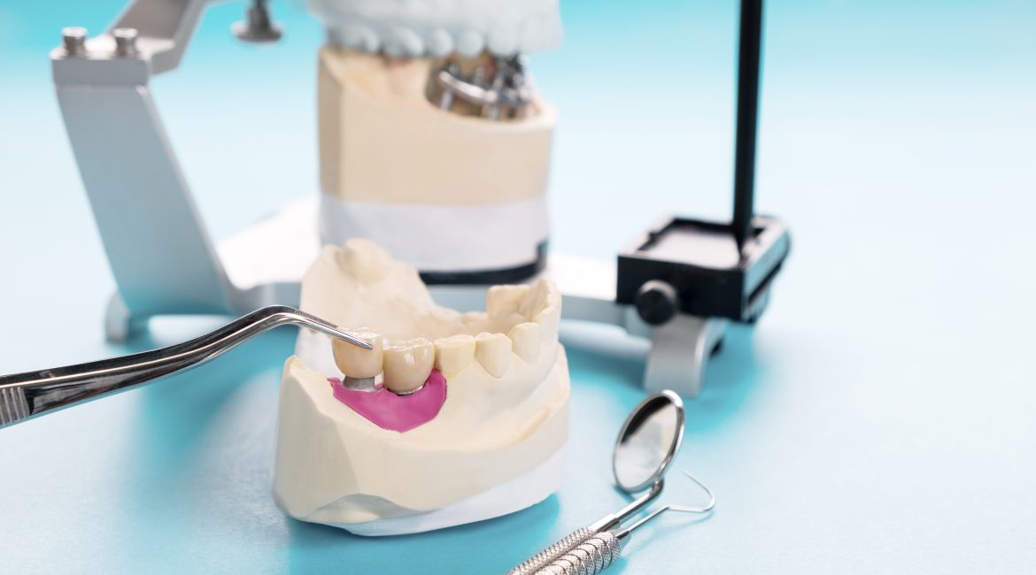 Dental Implants Care Tips