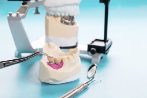 Dental Implants Care Tips